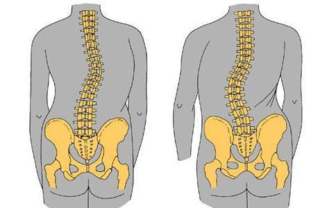 如何判斷孩子是否脊柱側(cè)彎,？家庭自測方法解析