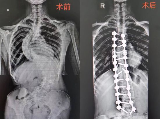 如何判斷孩子是否脊柱側(cè)彎,？家庭自測方法解析